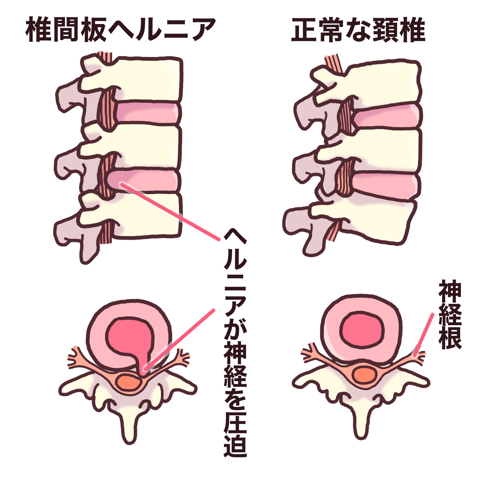 椎間板 ヘルニア 頚椎