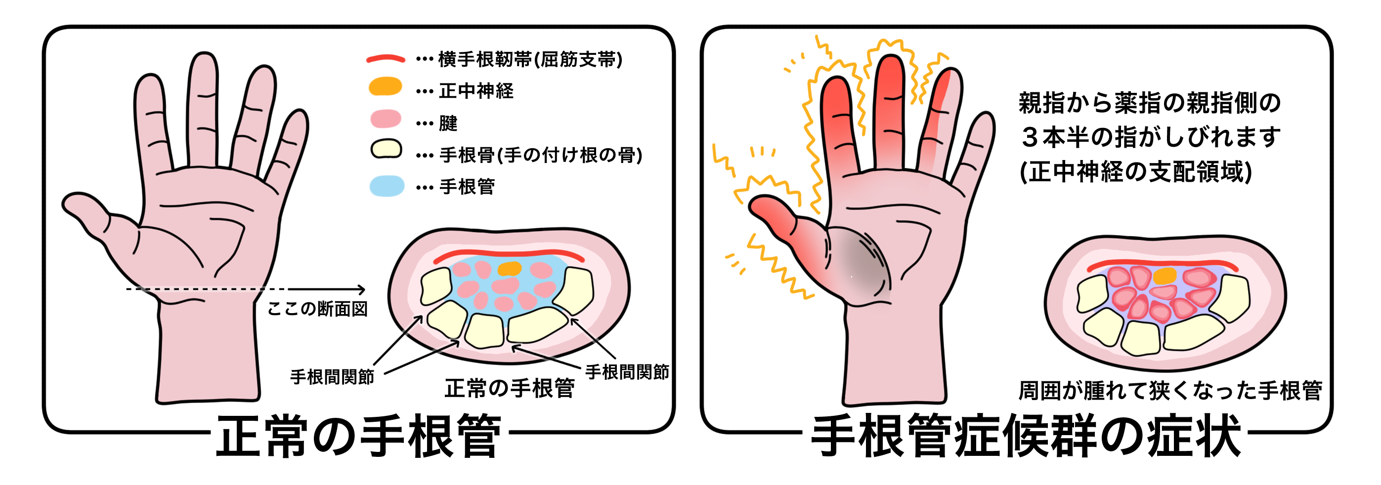 シュミット症候群は平均余命にどのように影響しますか?